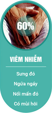Gây viêm nhiễm nam khoa